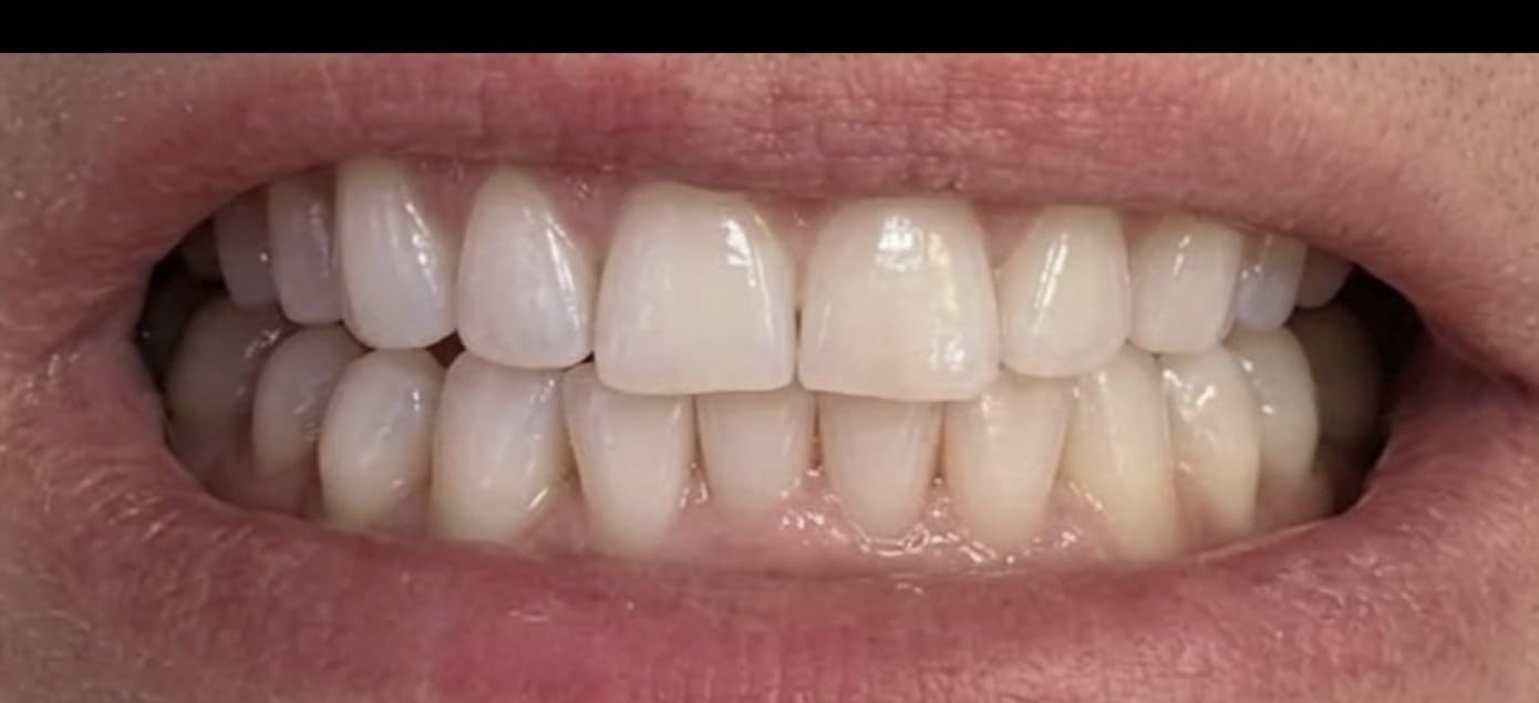 Crest 3DWhitestrips 1 Week Smile Transformation At-Home Teeth Whitening Kit, 14 Treatments, 8 Levels Whiter in 1 Week customer photo 1
