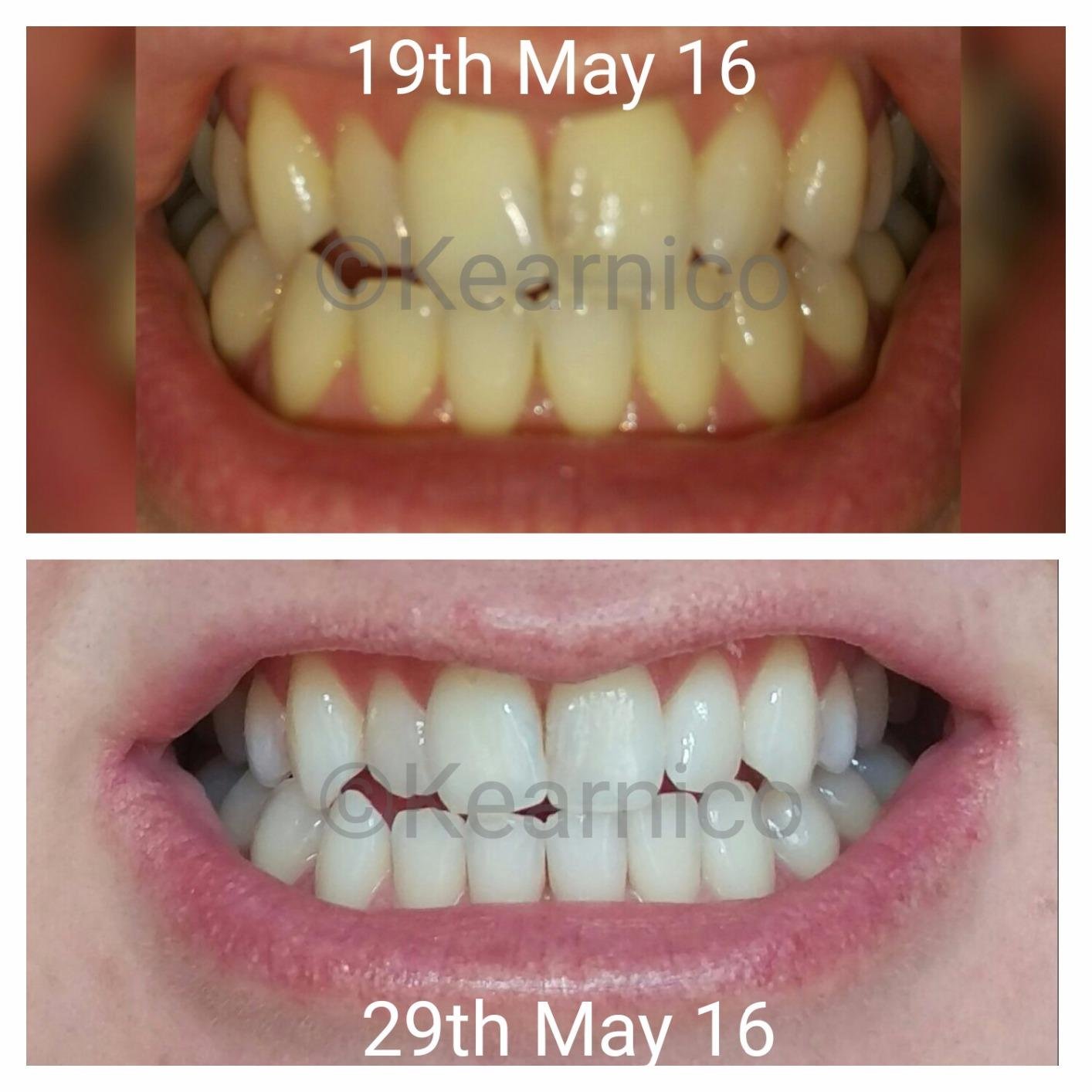 Crest 3DWhitestrips 1 Week Smile Transformation At-Home Teeth Whitening Kit, 14 Treatments, 8 Levels Whiter in 1 Week customer photo 2
