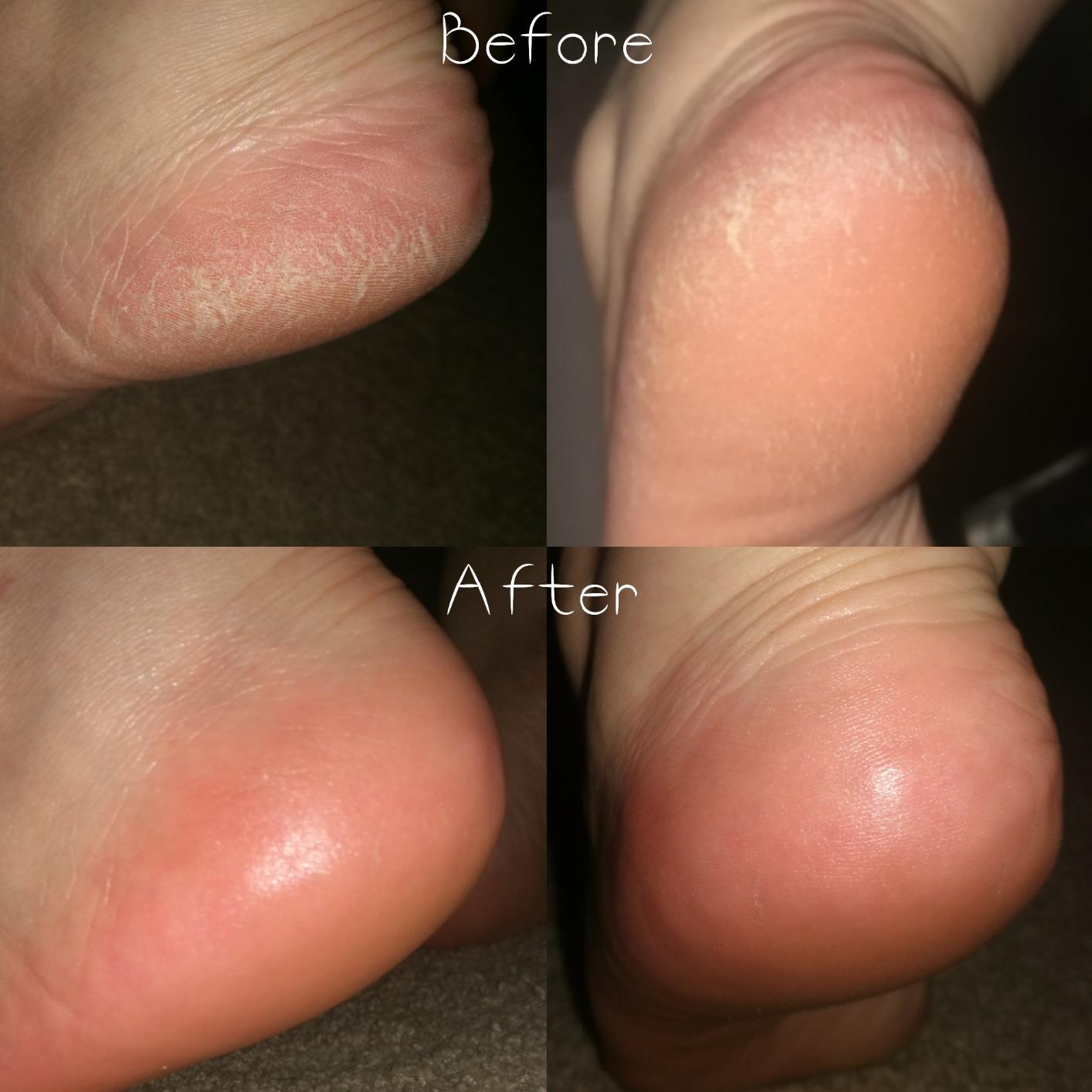 Amopé Pedi Perfect Electric Callus Remover Foot File w/ Diamond Crystals, Pedicure Tool for Feet, Removes Hard & Dead Skin, Feet Scrubber & Buffer, Splashproof, w/ Extra Coarse Roller Head, 1 Count customer photo 2
