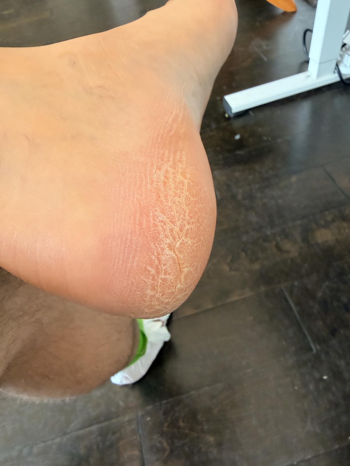Colossal Foot rasp Foot File and Callus Remover. Best Foot Care Pedicure Metal Surface Tool to Remove Hard Skin. Can be Used on Both Wet and Dry feet, High Grade Stainless Steel File customer photo 1