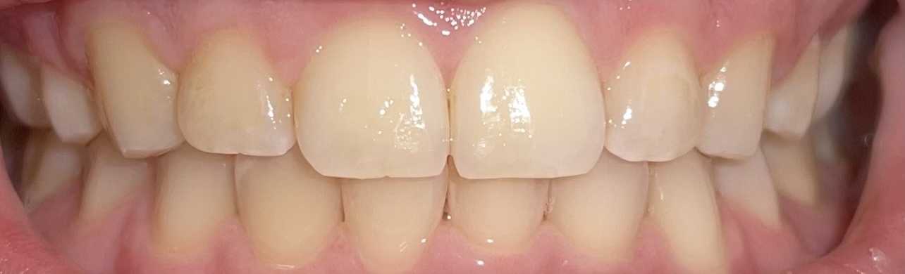 Crest 3D Whitestrips Express Whitening with Light, Whitestrips 3D White, Teeth Whitening Strip Kit, 20 Strips (10 Count Pack), Crest Teeth Whitening Strips, Teeth Whitening Kit customer photo 2