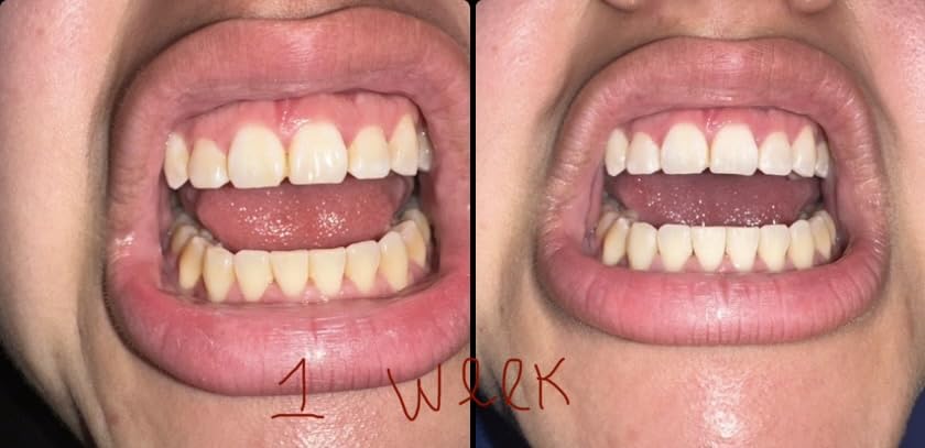 iSmile Teeth Whitening Kit - LED Light, 35% Carbamide Peroxide, (3) 3ml Gel Syringes, (1) Remineralization Gel, and Tray. customer photo 1