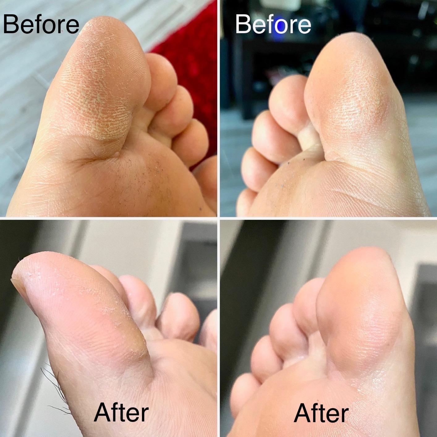 Electric Foot Callus Remover Kit, Elmchee Rechargeable Callous removers 3 Grinding Heads Waterproof Foot Scrubber File, Professional Pedicure Tools kit Feet Care for Dead, Cracked Dry Skin customer photo 2
