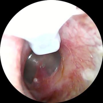 LEIPUT Ear Wax Removal - Ear Cleaner with 1080P Camera - FSA&HSA Black customer photo 1