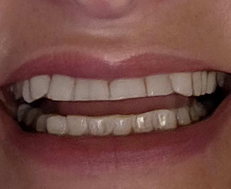 GuruNanda Teeth Whitening Strips - 4X Whiter Teeth, 7-Day Whitening Kit customer photo 2