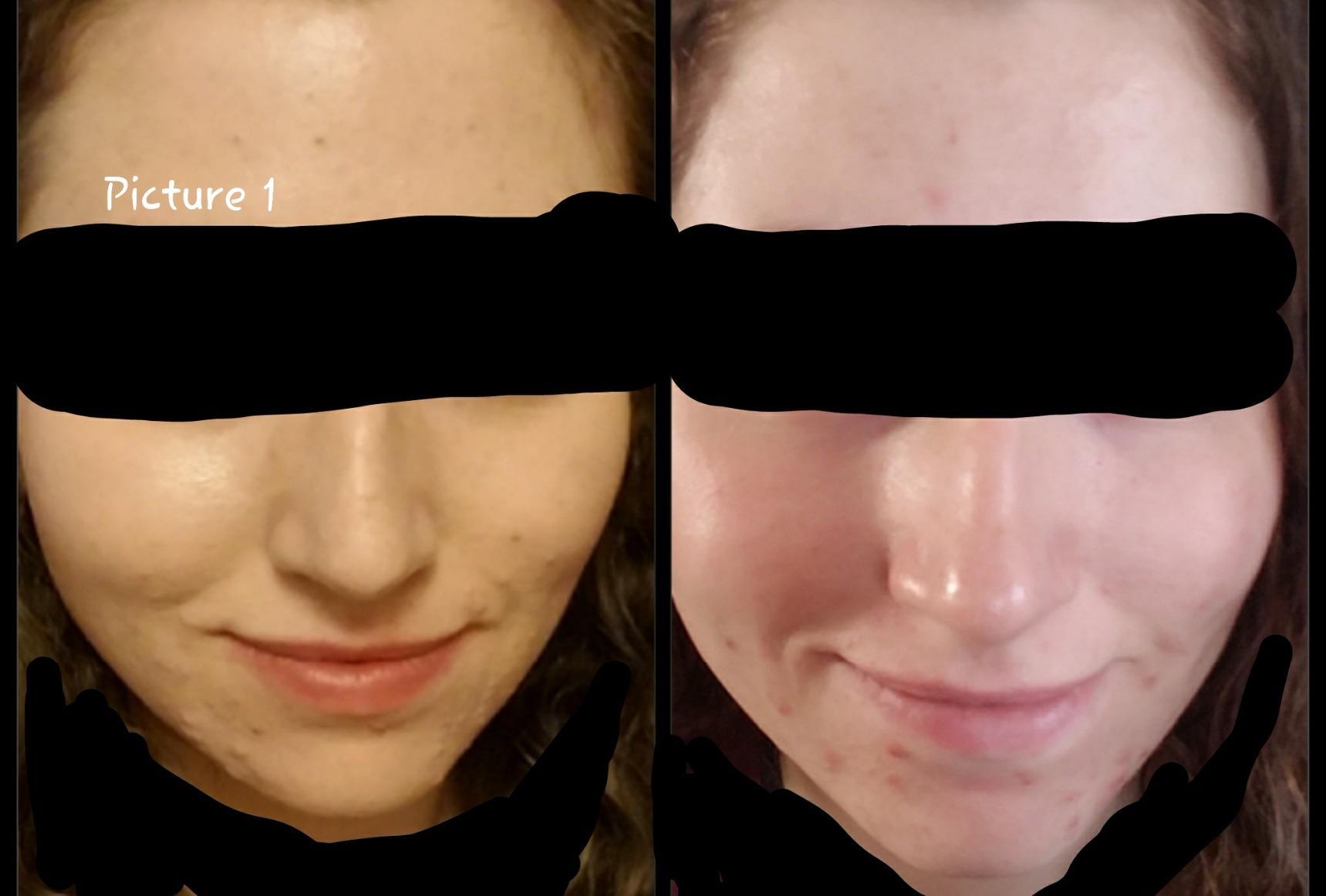 CeraVe Renewing Salicylic Acid Cleanser, Gentle Exfoliating Face Wash, 16oz customer photo 1